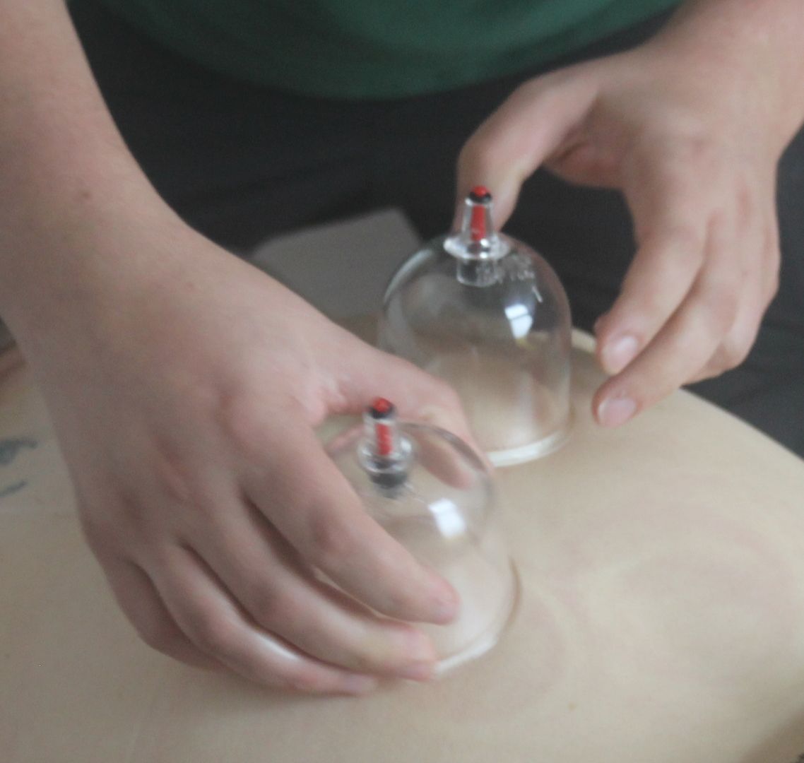 Ein Mitarbeiter der Praxis führt eine Schröpfmassage bei einen Patienten durch.